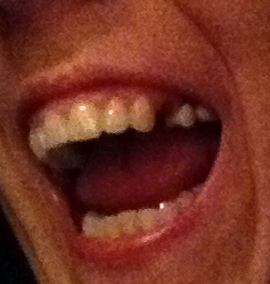 I'm giving a mouth-open grin and there is an obvious space on the left side of my face where a tooth should be.