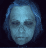 A UV photo of my face taken at a skin clinic shows loads of dark spots and damage in deeper levels of the skin.